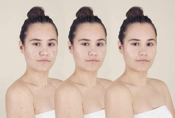 痘痘前后图片下载