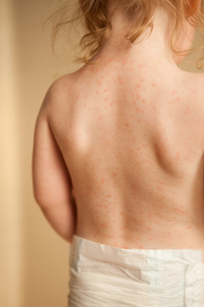 小女孩因对抗生素过敏而起疹子素材图片