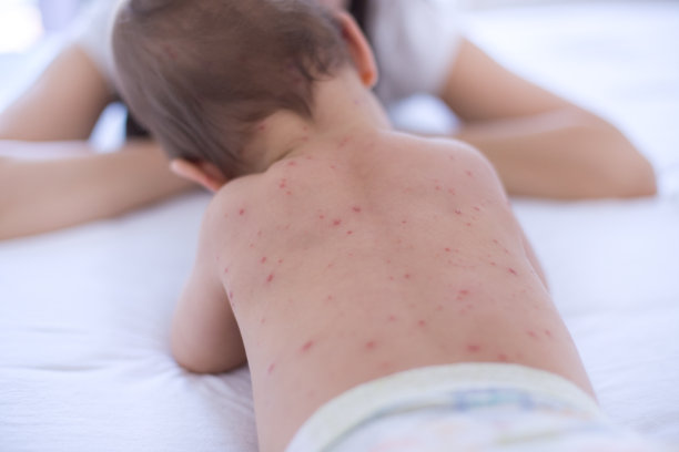 背部有水痘素材图片