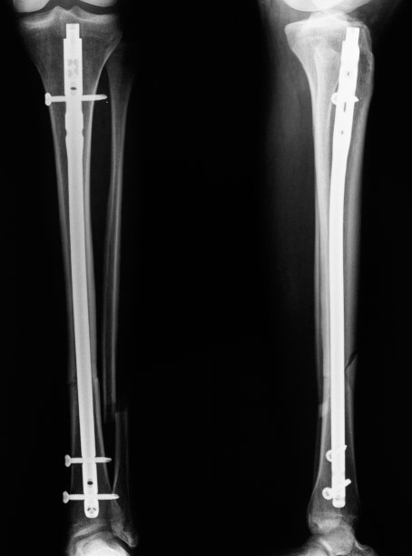 胫骨和腓骨x线照片图片下载