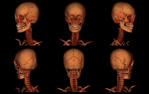颈动脉CT血管造影图片下载