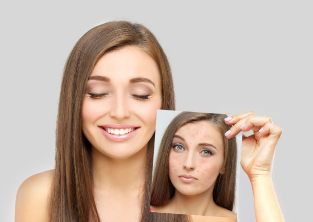 痤疮后的痕迹，肖像美丽的女孩与问题和清楚的皮肤图片下载