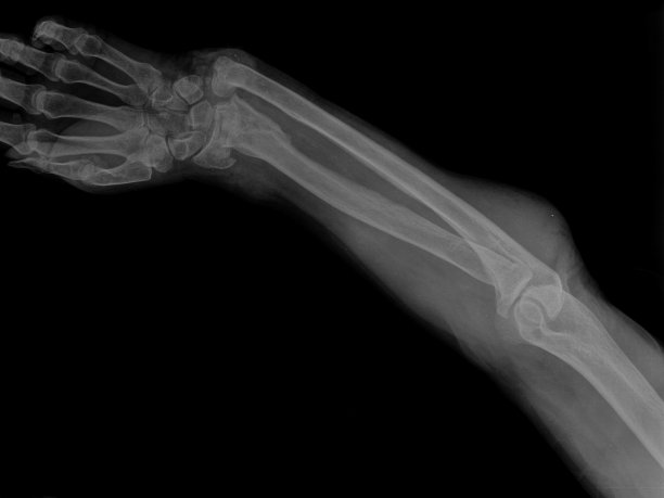 骨折手臂的x线照片图片下载