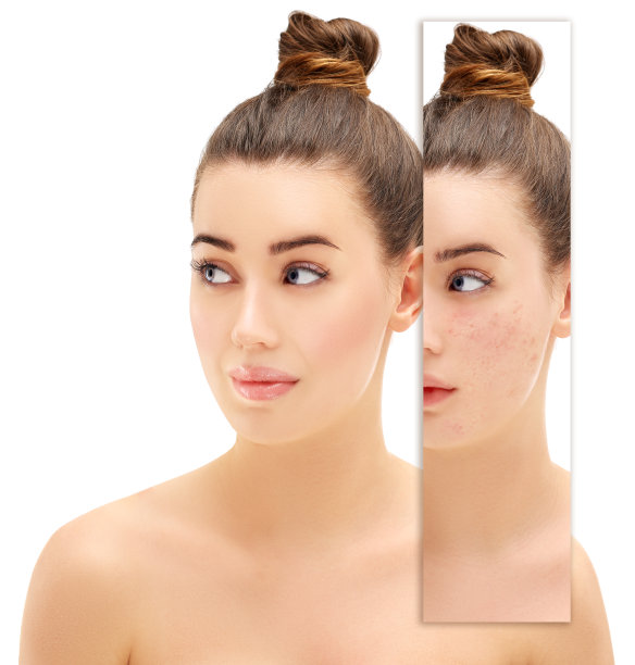 Post-Acne标志图片下载