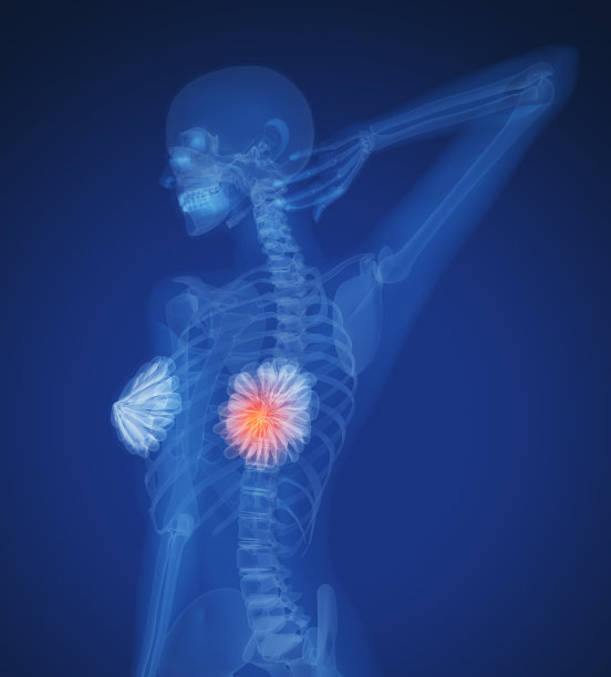 乳腺癌图片下载