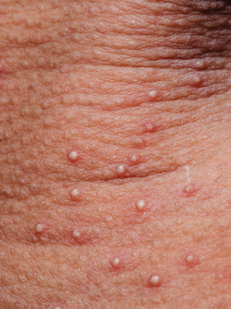 有皮疹的皮肤毛囊炎素材图片