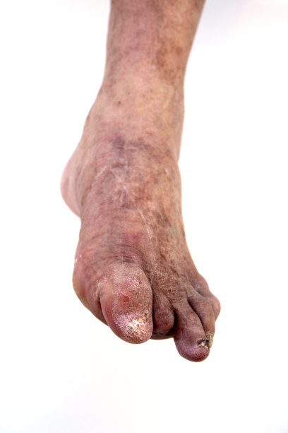 糖尿病足图片下载