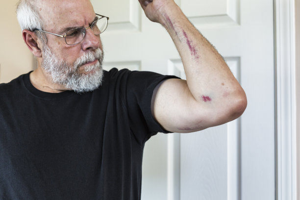 老人正在检查受伤的手臂图片下载