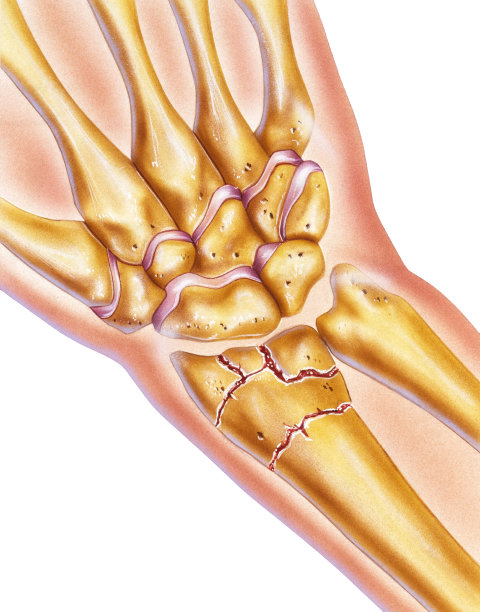 手和手腕骨折图片下载