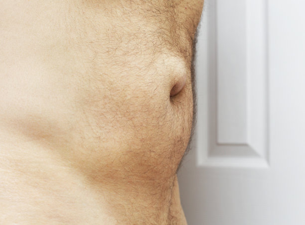 脐疝侧视图图片下载