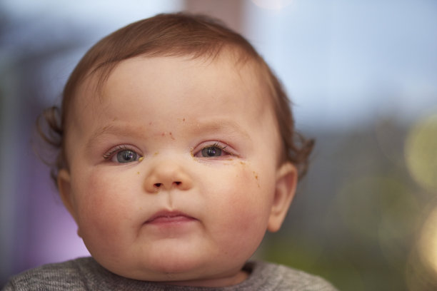 结膜炎或红眼图片下载