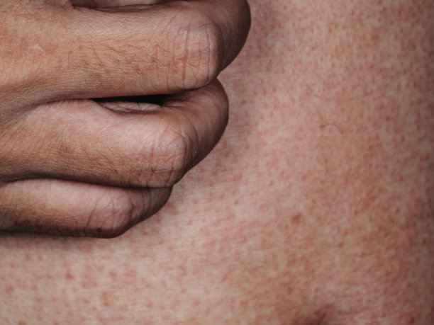 有皮疹的皮肤毛囊炎素材图片