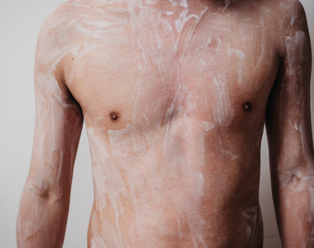 患有皮肤毛囊外炎伴皮疹的男子素材图片