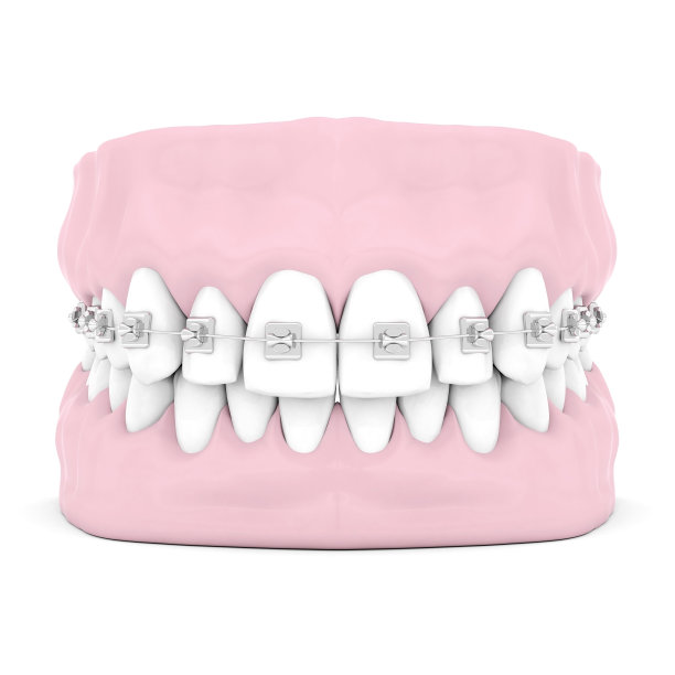 牙科牙套图片下载