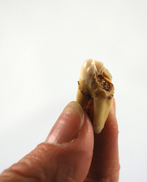 手指托着腐烂的臼齿图片下载