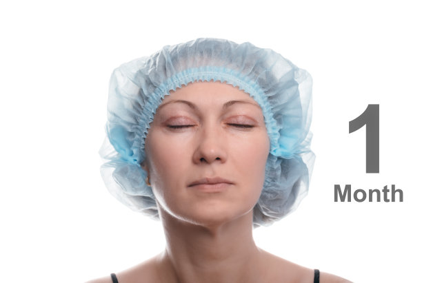 上眼睑的眼睑成形术图片下载