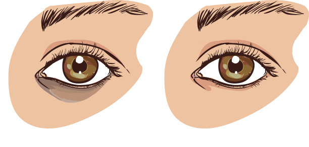 那个女人的脸上有黑眼圈。眼部肌肤护理理念。之前和之后图片下载