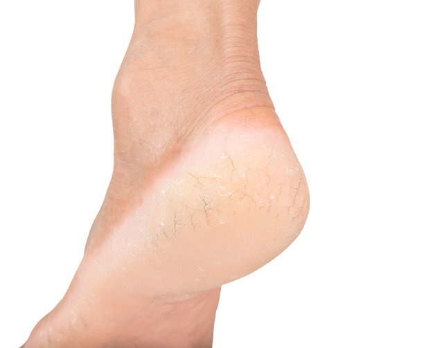 脚跟干裂的图片下载