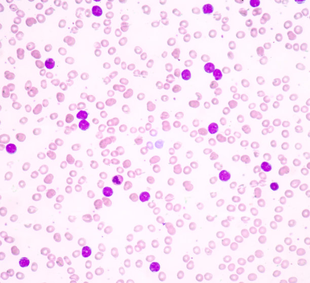 急性淋巴细胞白血病(ALL)图片下载