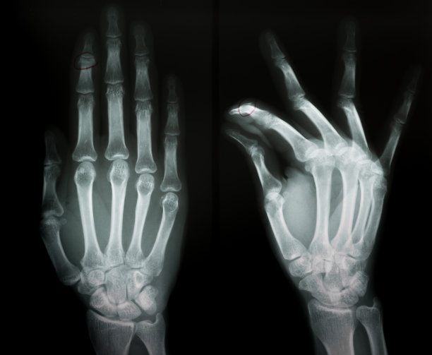 第二指骨骨折x线片图片下载