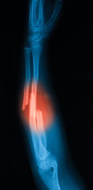 前臂尺骨和桡骨骨折x线照片。图片下载