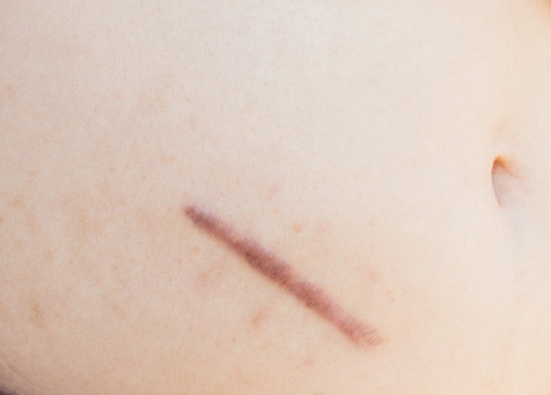 手术留下的伤疤图片下载