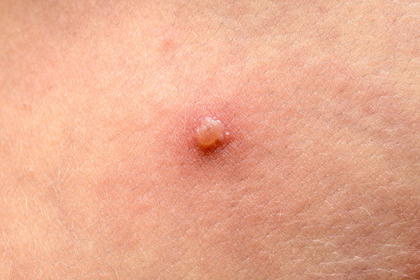 水痘带状疱疹病毒或水痘泡疹对儿童、婴儿素材图片