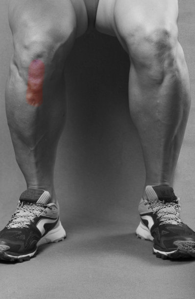 髌腱炎图片下载