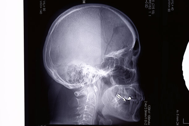 人类头骨X光片的侧面图图片下载