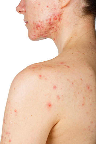 有皮肤问题的年轻女孩图片下载