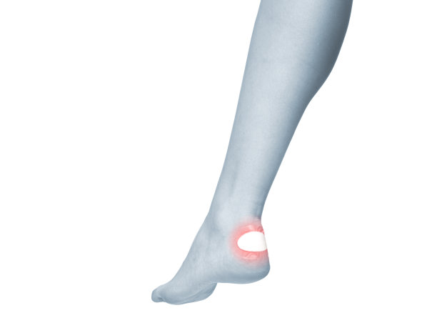 治疗脚后跟的水泡。图片下载