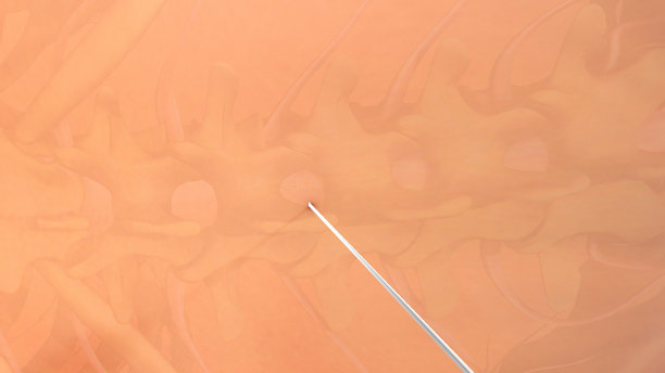 脊髓麻醉图片下载