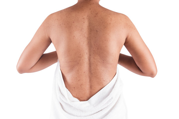 身体皮肤痤疮图片下载