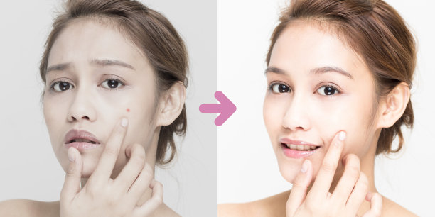 年轻女性的痤疮护理前后素材图片
