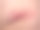 蜱虫叮咬引起的莱姆病图片下载