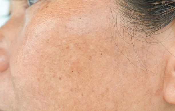 脸上的雀斑。图片下载