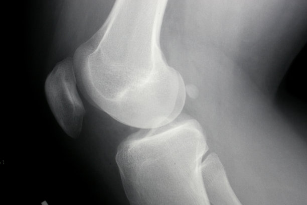 膝盖X光侧位片图片下载