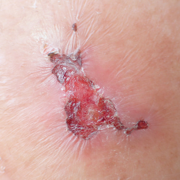 糖尿病患者的伤口图片下载