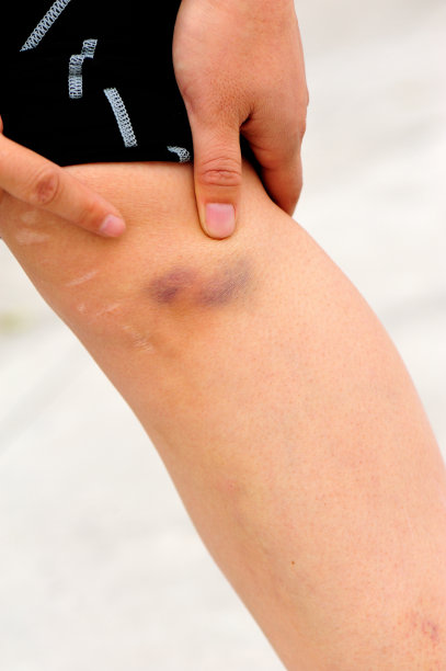 运动受伤的膝盖图片下载