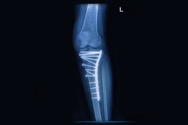 胫骨(腿骨)骨折x线片。胫骨与内固定图片下载