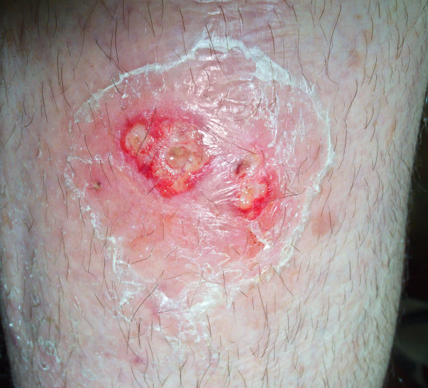 腿部葡萄球菌感染图片下载