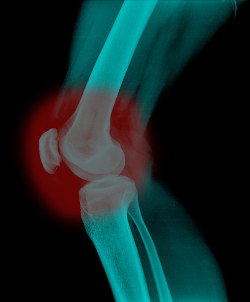 人类膝盖的x光片图片下载