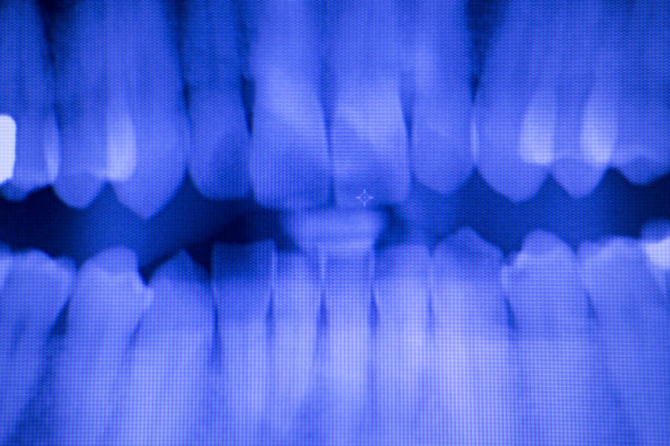 牙科补牙医师进行x光扫描图片下载