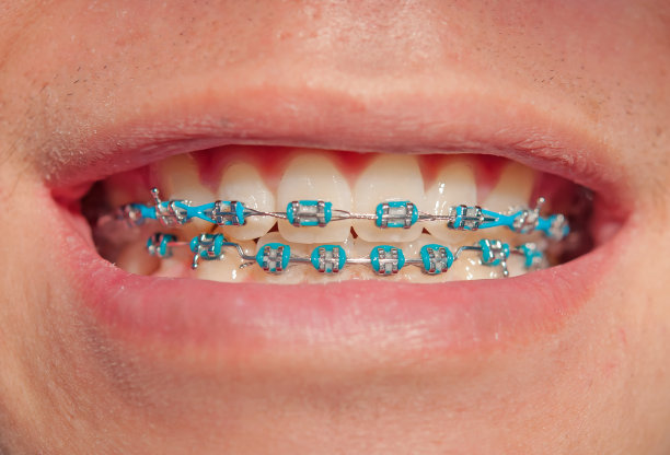 一个快乐的少年男孩的特写微笑着戴上牙套图片下载