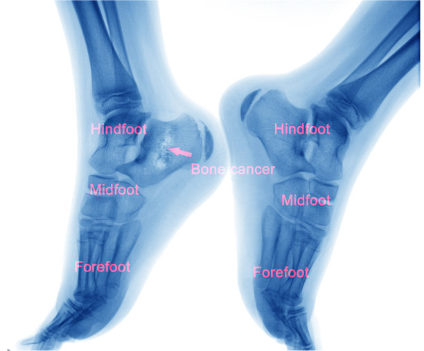 骨癌图片下载