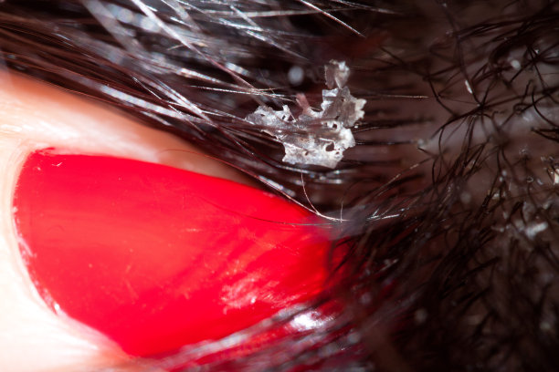 头皮屑的问题图片下载