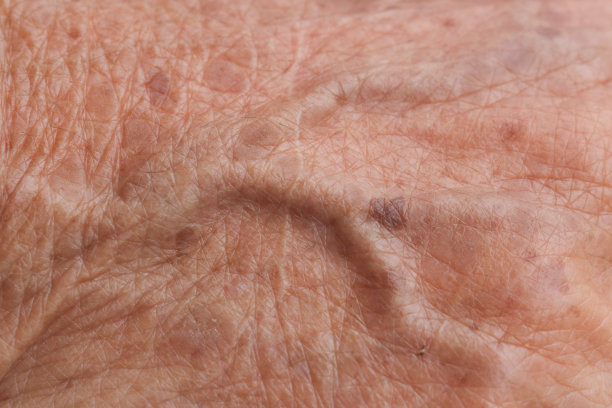 老妇人皮肤血管图片下载