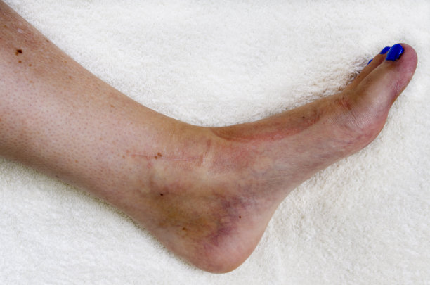 手术后脚踝骨折图片下载