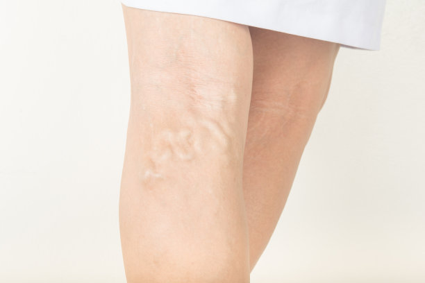 老年妇女静脉曲张图片下载