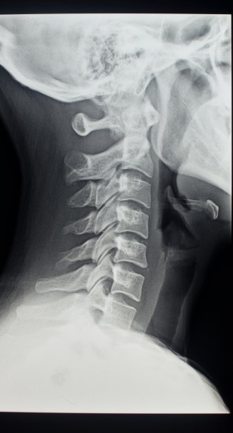 颈椎x光图片下载